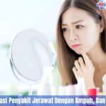 5 Cara Mengatasi Jerawat Dengan Ampuh, Dan Terbukti Aman