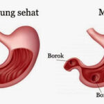 Cara Mengatasi Penyakit Maag Beserta Beberapa Solusinya