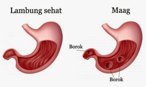 Cara Mengatasi Penyakit Maag Beserta Beberapa Solusinya