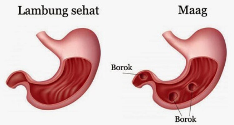 Cara Mengatasi Penyakit Maag Beserta Beberapa Solusinya