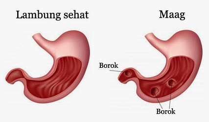 Cara Mengatasi Penyakit Maag Beserta Beberapa Solusinya