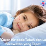 Gejala Cacar Air pada Tubuh dan Langkah Perawatan yang Tepat
