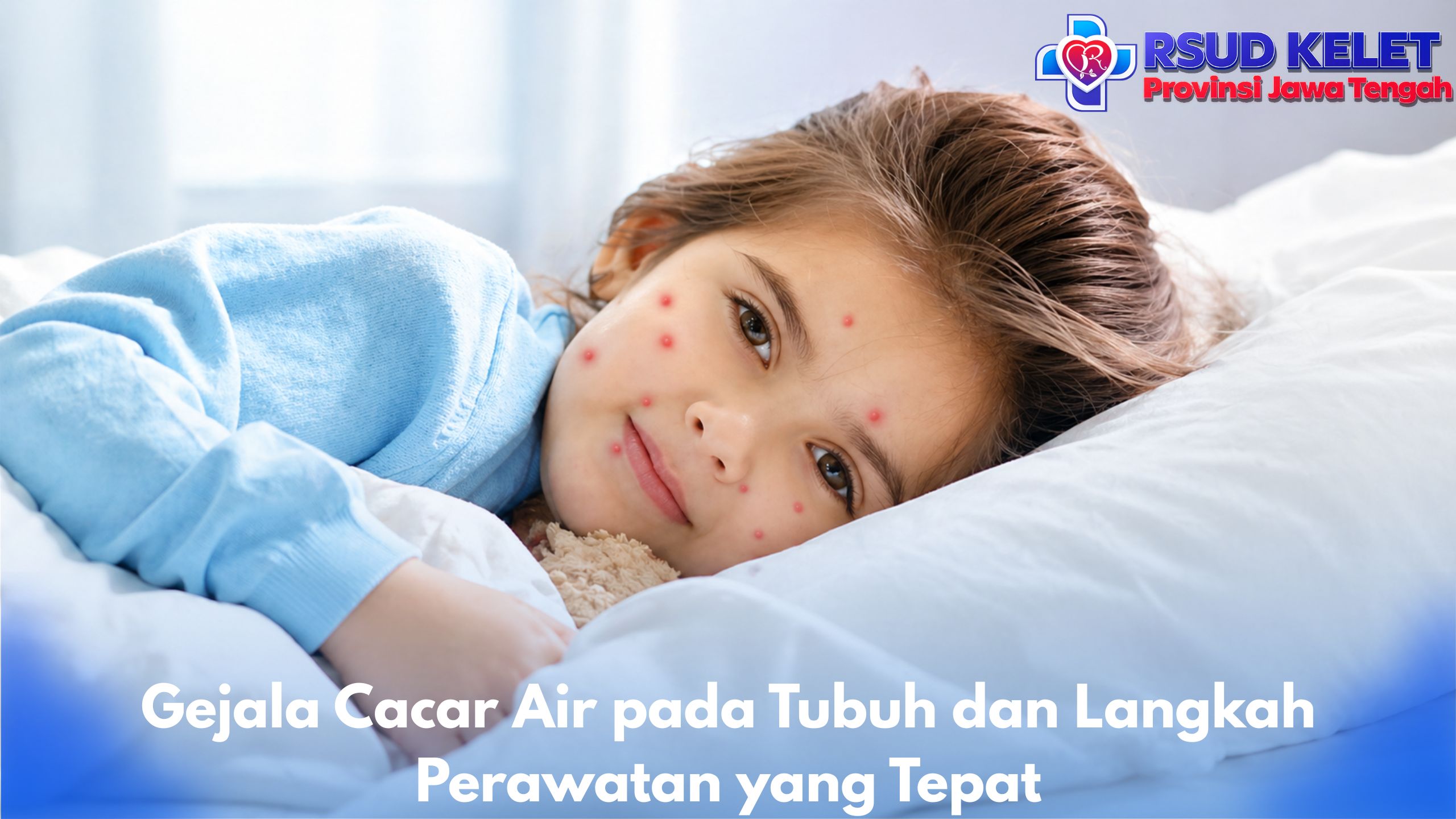 Gejala Cacar Air pada Tubuh dan Langkah Perawatan yang Tepat