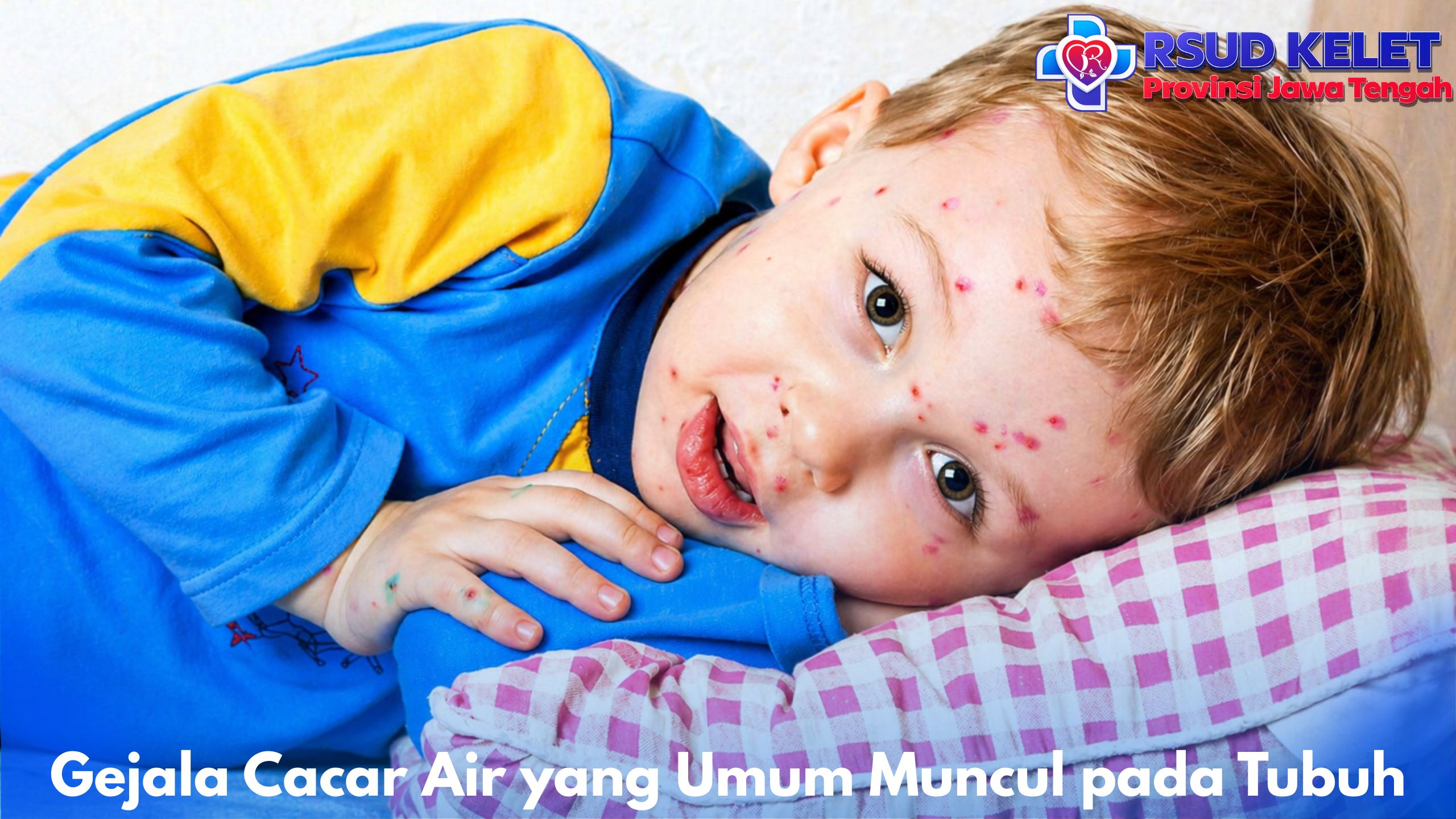 Gejala Cacar Air yang Umum Muncul pada Tubuh