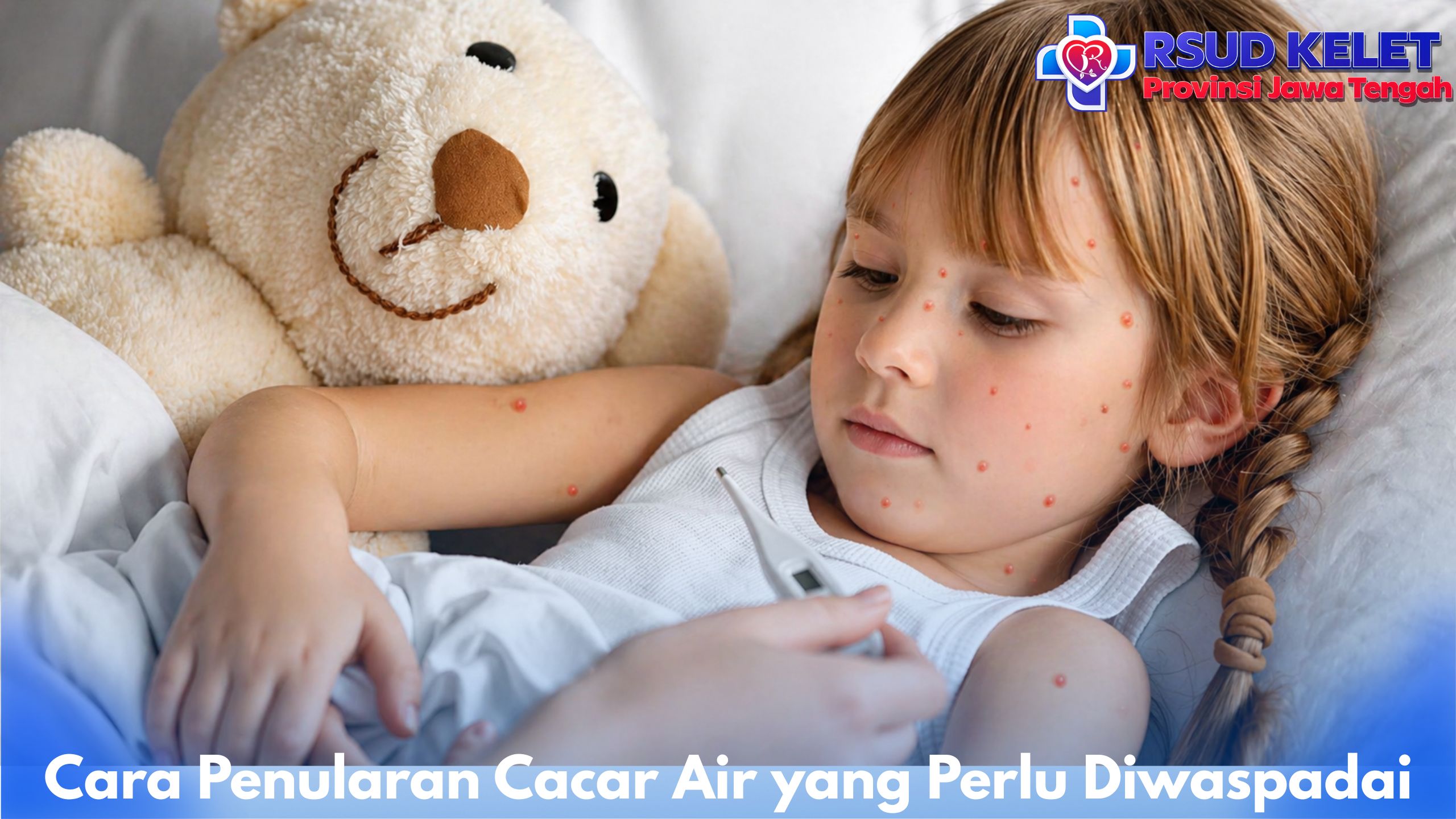 Cara Penularan Cacar Air yang Perlu Diwaspadai