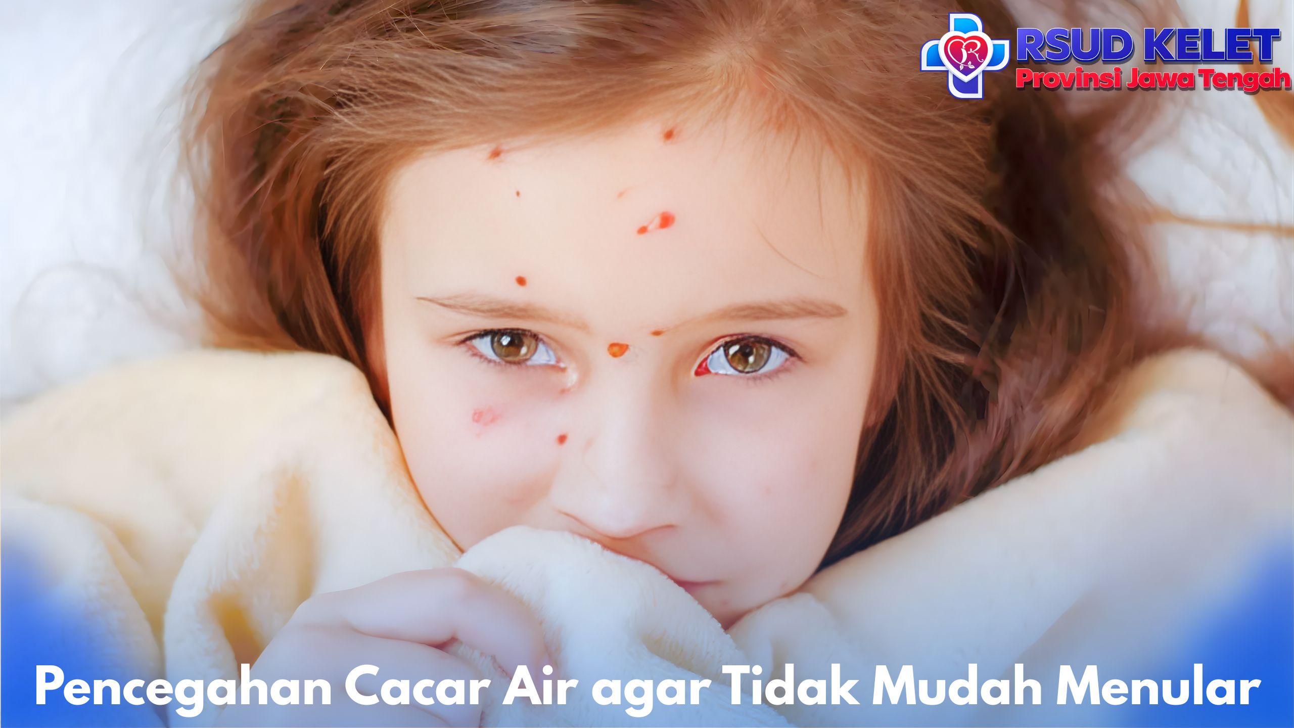 Pencegahan Cacar Air agar Tidak Mudah Menular