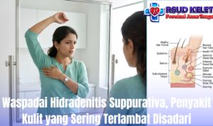 Waspadai Hidradenitis Suppurativa, Penyakit Kulit yang Sering Terlambat Disadari