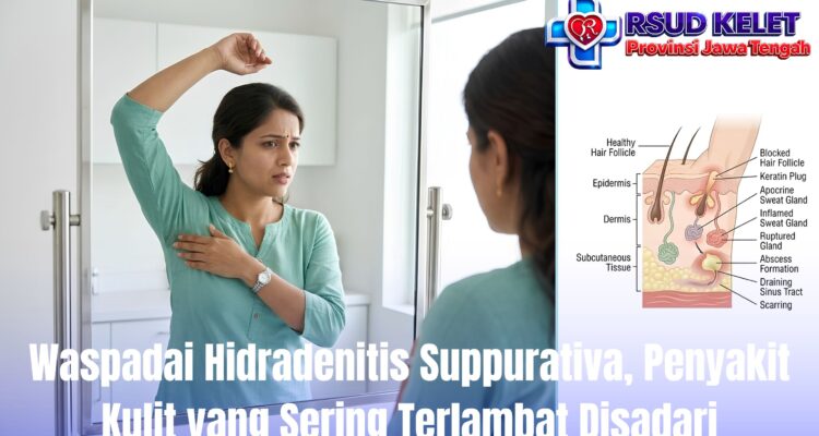Waspadai Hidradenitis Suppurativa, Penyakit Kulit yang Sering Terlambat Disadari