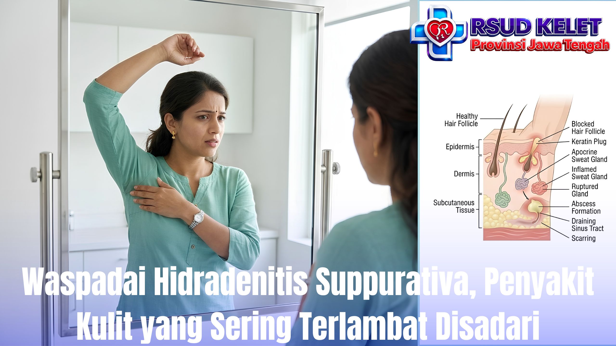 Waspadai Hidradenitis Suppurativa, Penyakit Kulit yang Sering Terlambat Disadari