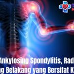 Penyakit Ankylosing Spondylitis, Radang Sendi Tulang Belakang yang Bersifat Kronis