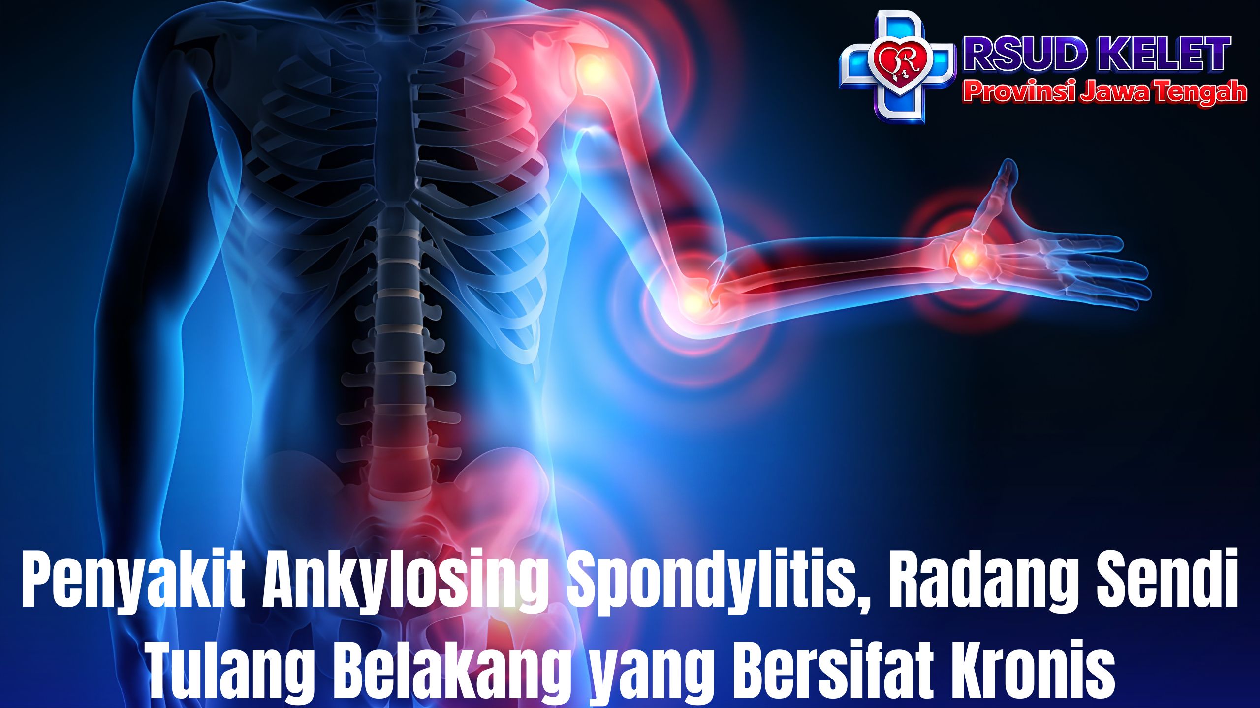 Penyakit Ankylosing Spondylitis, Radang Sendi Tulang Belakang yang Bersifat Kronis
