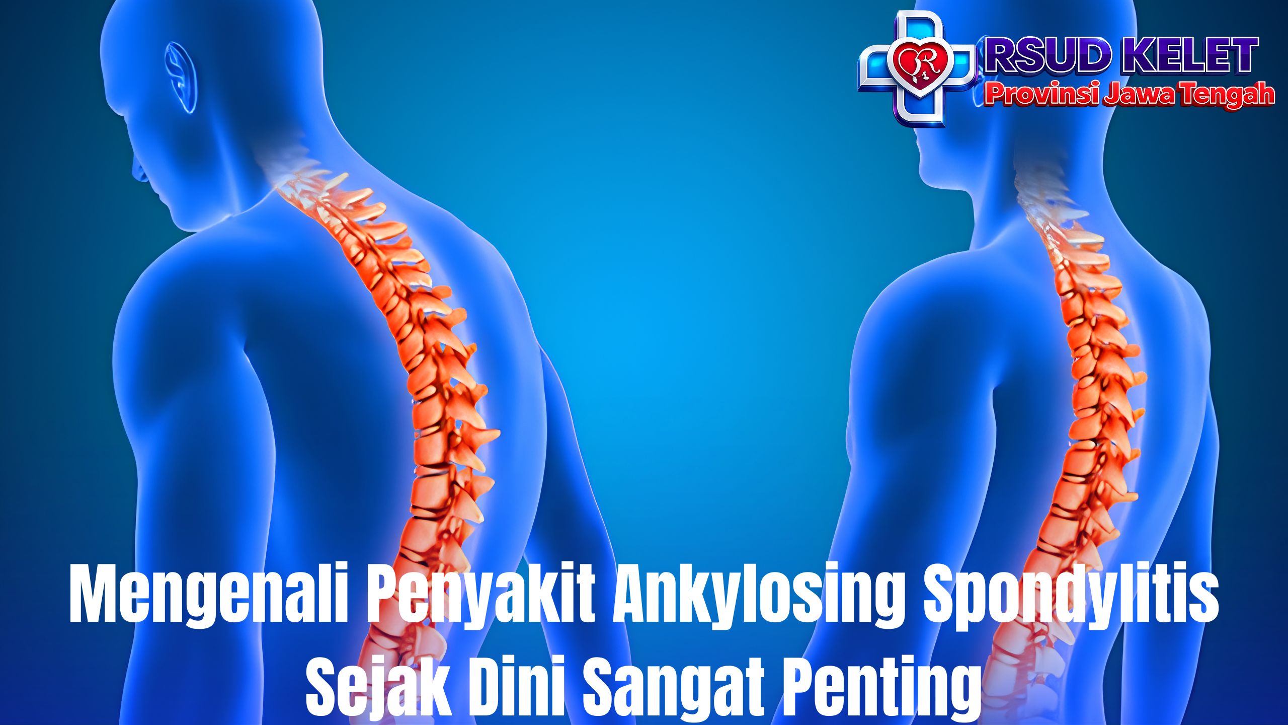 Mengenali Penyakit Ankylosing Spondylitis Sejak Dini Sangat Penting