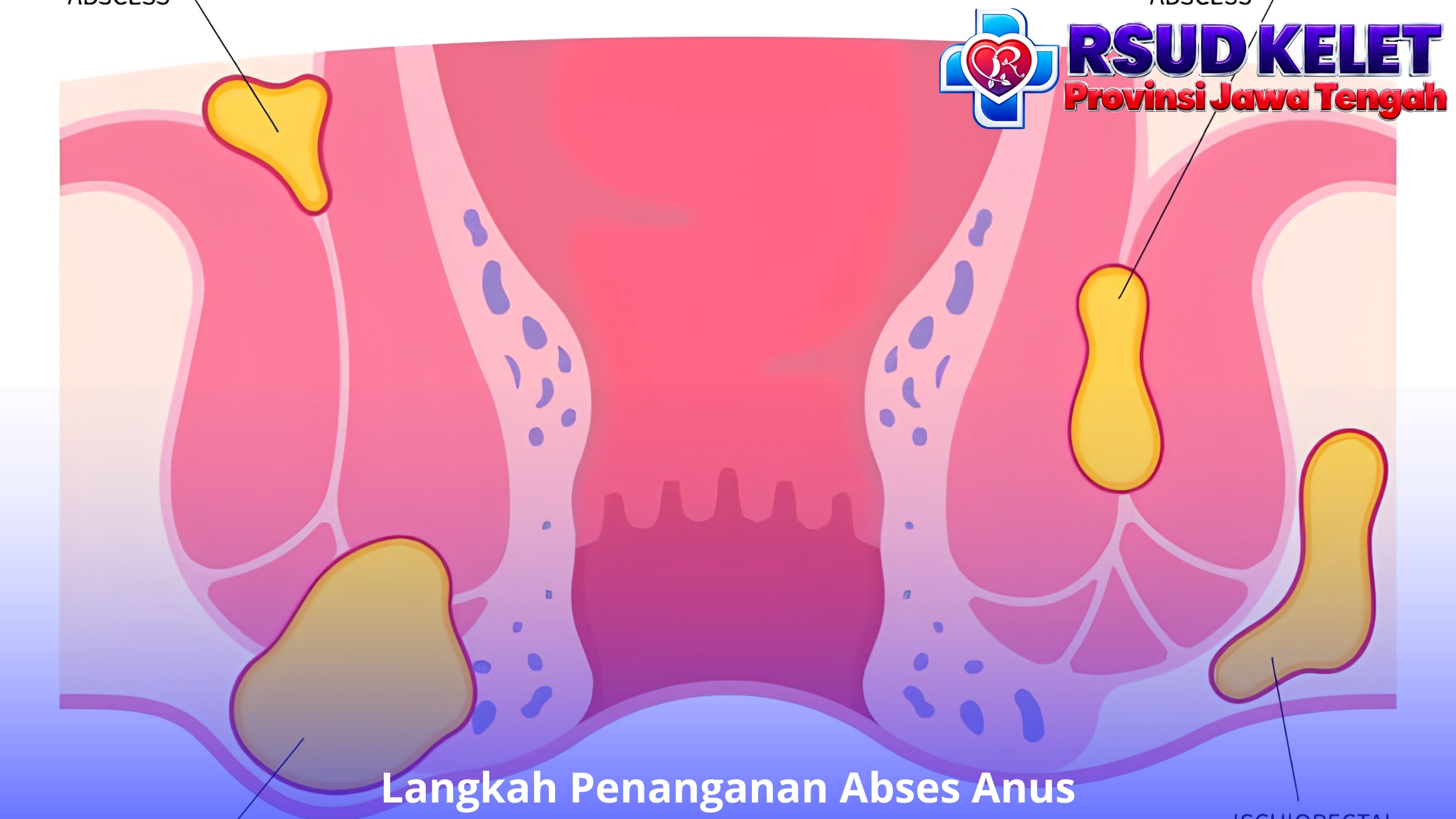 Langkah Penanganan Abses Anus