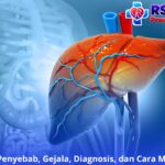 Abses Hati: Penyebab, Gejala, Diagnosis, dan Cara Mengatasinya