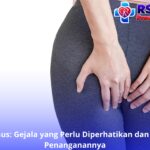 Abses Anus: Gejala yang Perlu Diperhatikan dan Langkah Penanganannya