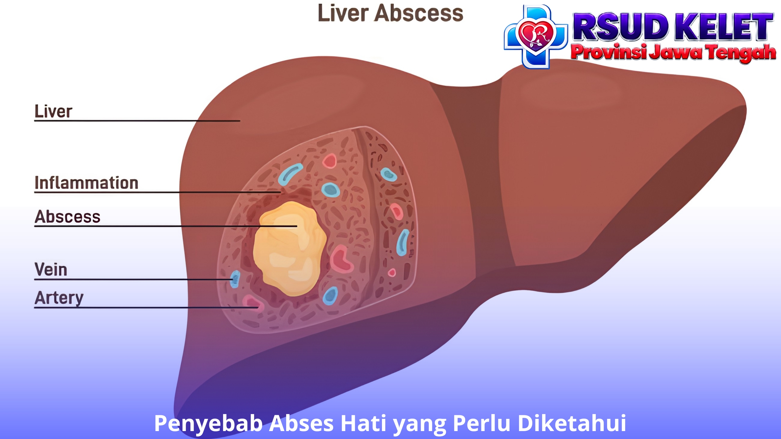 Penyebab Abses Hati yang Perlu Diketahui