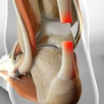 Achilles Tendon Rupture, Cedera pada Kaki yang Perlu Diwaspadai