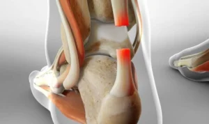 Achilles Tendon Rupture, Cedera pada Kaki yang Perlu Diwaspadai