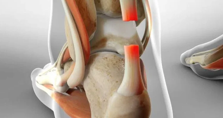 Achilles Tendon Rupture, Cedera pada Kaki yang Perlu Diwaspadai