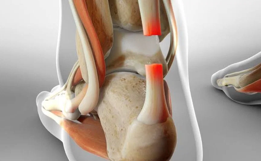 Achilles Tendon Rupture, Cedera pada Kaki yang Perlu Diwaspadai