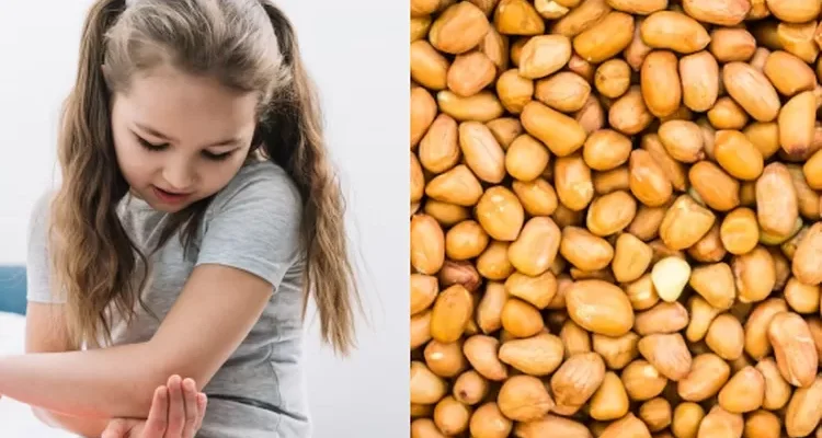 Mengenal Alergi Kacang, dari Penyebab hingga Gejala yang Perlu Diwaspadai Mengenal Alergi Kacang, dari Penyebab hingga Gejala yang Perlu Diwaspadai