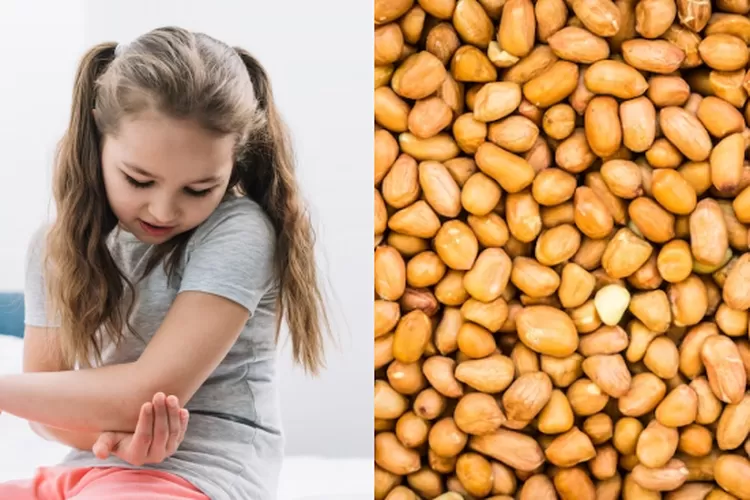 Mengenal Alergi Kacang, dari Penyebab hingga Gejala yang Perlu Diwaspadai