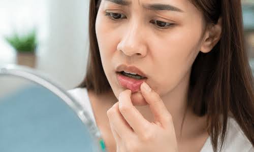 Aktinomikosis Bukan Penyakit Menular, tetapi Tetap Perlu Ditangani